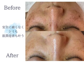 ディアスマイル(Dear.smile)/安全に痛みなくシミも肌質改善も