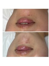 エミレーブ シロカネ(Hemireve Shirokane)/1:1のパーソナライズ肌管理