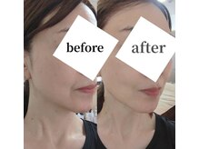 ビノワドットウミ(binowa.umi)の雰囲気（NEW切らない糸リフト）