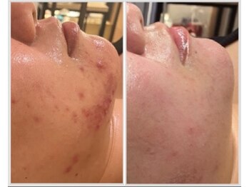 美しぐれ 溝の口/【1年】LDM/ピーリング/プラズマ