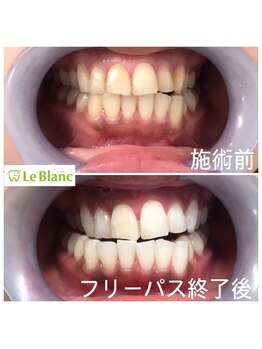 ルブラン 奈良店(Le Blanc)/必ず映える歯!!