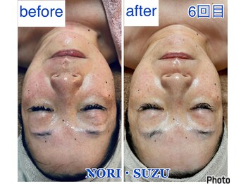 ノリスズ(NORI SUZU)/30％ヒト幹細胞×エクソソーム