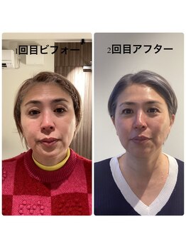 アネラ(ANERA)/小顔矯正&毛穴洗浄BeforeAfter