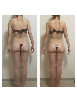 ホズリル(Hozril)/全身痩身100分コース