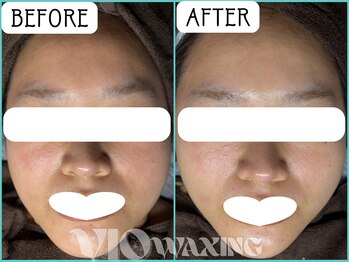 ヴィオワクシング(VIO WAXING)/女性に人気！フェイスワックス