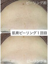 スティーン(Styin)/ピーリング【京丹後・与謝野町】