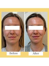 クローバー(clover)/【before/after】施術１回目直後