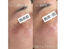 イリス(Iris)の雰囲気（年々増えるシミは早めのIPL光フェイシャル一択！美肌への近道◎）