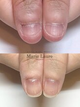 マリーロール 梅田店(Marie Laure)/自爪育成/深爪矯正/ネイルケア