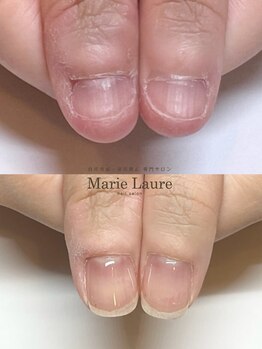 マリーロール 梅田店(Marie Laure)/自爪育成/深爪矯正/ネイルケア