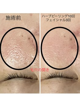 エメ 心斎橋(Aimer)/ハーブピーリングで毛穴の引締め