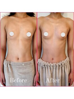 ティアラ(TIARA)/バストアップ症例