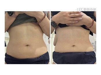 メディカルエステ 新宿店/＊日本初-12℃脂肪冷却症例＊