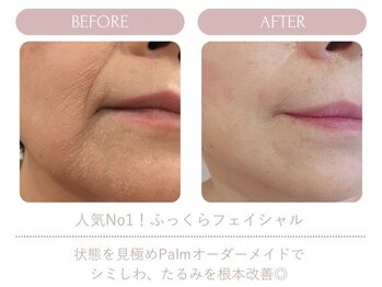 パーム(Palm)/ほうれい線もふっくらと