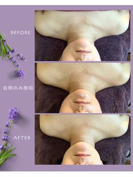 エステティックジュビラン アメジスト/フェイシャル&3Dリフトセラピー