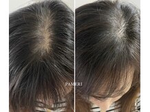 パメリ(PAMERI)の雰囲気(ミノキシジル×エクソソームで頭皮に栄養◎髪の密度UP◎)