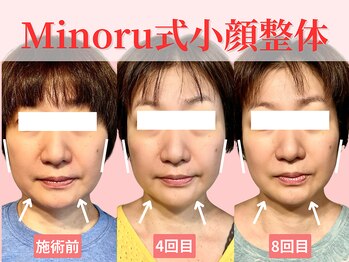 フレキシボディ(FlexiBody)/小顔施術ビフォーアフター #1