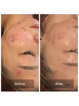 リバース 大阪店(Rebirth)/ハーブの力で肌質改善