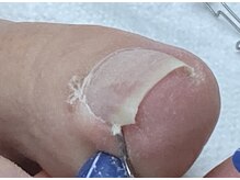 レヴィア(Revia)/巻き爪ケア