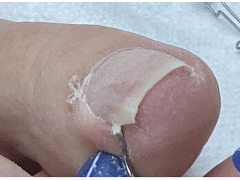 レヴィア(Revia)/巻き爪ケア