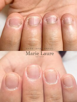 マリーロール 梅田店(Marie Laure)/自爪育成/深爪矯正/ネイルケア