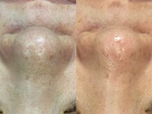 ヴィーヴ 京橋(vive)/【韓国式3D毛穴洗浄】