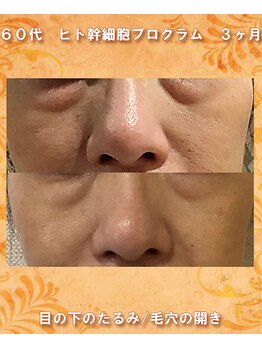 ナイア(naia)/ヒト幹細胞プログラム症例