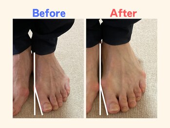 ピース/足指の曲がりにお悩みの50代女性