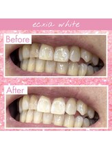 エクシアホワイトニング 前橋店/ビフォーアフター