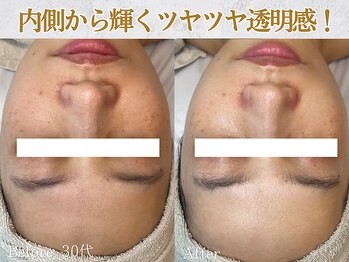 ぷるる 練馬 江古田/30代 ララピール+ゲルマスク