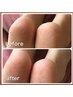 【フットケア】　足裏の角質ケア&フットマッサージ
