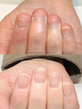 マリーロール 梅田店(Marie Laure)/自爪育成/深爪矯正/ネイルケア