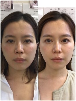 たんぽぽ鍼灸整体院/たんぽ式小顔矯正で小顔に!