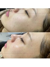 アモール 丸亀店(Amor)/眉毛/まつげパーマ/毛穴/脱毛