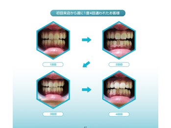 サロン ド スカイ(Salon de sky)/ホワイトニング7