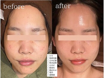 アンシャンテ 神戸元町店(Enchante)/毛穴洗浄ピーリングフェイシャル