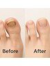 巻き爪 変色【トラブルネイル】改善集中ケア ¥6600