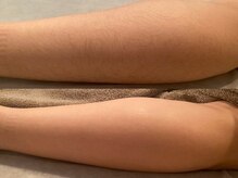 ディオーネ 西船橋駅前店(Dione)/ひざ下脱毛◇Before After