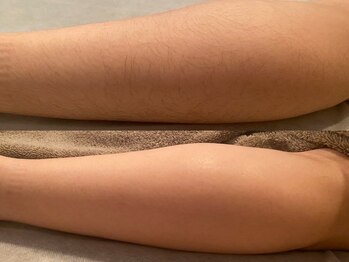 ディオーネ 西船橋駅前店(Dione)/ひざ下脱毛◇Before After