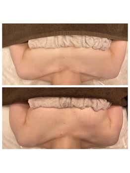 エパノーラ 名古屋(Epanoura)/1回の施術　前後写真