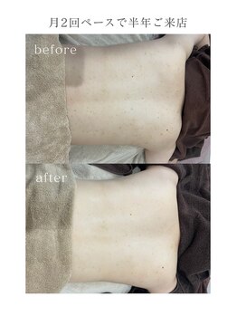 女神デトックス 長野店/《背中》陶肌トリートメント