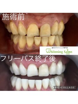 ホワイトニングサロン 札幌店/ 【ホワイトニング施術例】#札幌