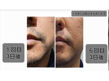 ラクト サロン(RAKT salon)/ヒゲ脱毛