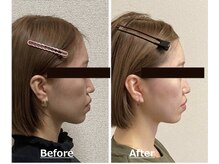 小顔22 ボルティ 赤坂支店(Bolty)/20代：施術5回（横顔）