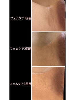 ラルゴ(Largo)/フェムケアビフォーアフター！