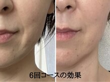 ミルアカ(Milu'aca)の雰囲気（初回からわかる小顔＆トーンＵＰ！年齢を忘れるエイジレス美）