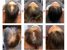 レメディ/グロスファクター育毛促進鍼