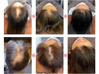 レメディ/グロスファクター育毛促進鍼