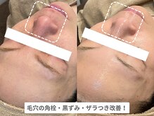 アンシャンテ 神戸元町店(Enchante)/毛穴洗浄ピーリングフェイシャル