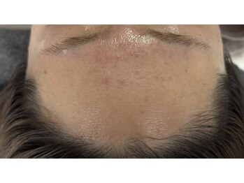 リアスキン(Lia skin)/ニキビでお悩みの方